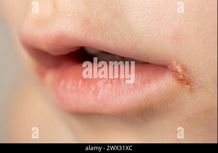 Krampfanfälle an den Mundwinkeln eines Kindes. Bakterielle Erkrankung der Lippenwinkelentzündung. Winkelstomatitis mit reduzierter Stockfoto