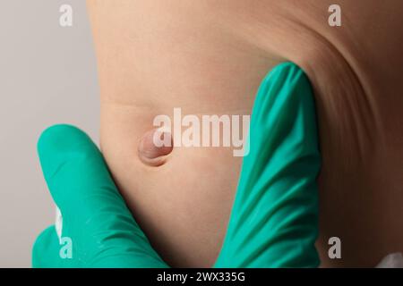 Ärzte Hände in grünen medizinischen Handschuhen untersuchen eine Nabelhernie bei einem Kind, Nahaufnahme. Probleme Stockfoto