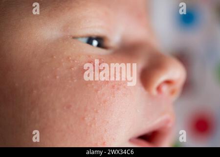 Allergische Pickel bei einem Neugeborenen im Gesicht. Pathogenese, Akne des Neugeborenen, Nahaufnahme Stockfoto