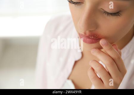 Frau mit Herpes, die Lippen vor verschwommenem Hintergrund berührt, Nahaufnahme Stockfoto