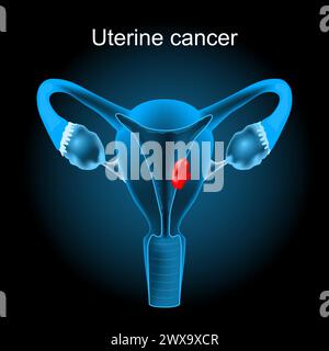 Uteruskarzinom. Querschnitt eines menschlichen Uterus mit Endometriumtumor. Das weibliche Fortpflanzungssystem. Vektorillustration wie Röntgenbild. Reproduktiv Stock Vektor
