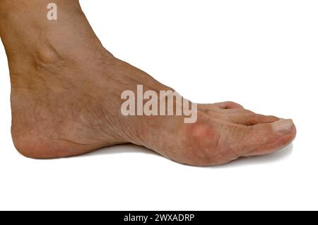 Linkes Bein mit schmerzhafter geschwollener Gichtentzündung, Anfangsstadium Stockfoto
