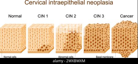 Zervikale Dysplasie. Unterschiede im Deckepithel bei zervikalen intraepithelialen Neoplasien. Epithelquerschnitt. Nahaufnahme einer norma Stock Vektor