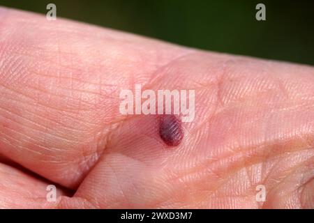 Nahblutblase auf der Handfläche einer offenen Hand. Stockfoto