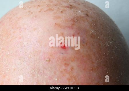 Vorbeugung, Weißer Hautkrebs. Nach der Laser-Behandlung beim Hautarzt bzw der Dermatologie: Die aktinische keratose, auch aktinische Präkanzerose oder solare keratose oder Licht-keratose - durch Strahlung hervorgerufen - ist eine lichtbedingte Hautveränderung. Es handelt sich um eine durch langjährige intensive Einwirkung von Sonnenlicht - sprich UV-Strahlung - verursachte chronische Schädigung der verhornten Oberhaut, typischerweise mit rötlichen, fest haftenden Schuppen auf der Haut. Die Hautschädigung schreitet nur langsam fort, kann aber nach Jahren in eine Form des Hautkrebses übergehen. Stockfoto