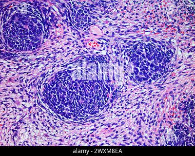 Mikroskopisches Bild eines Wilms-Tumors oder Nephroblastoms einer Kinderniere bei 200-facher Vergrößerung mit Hämatoxylin- und Eosin-Färbung eines der Mo Stockfoto