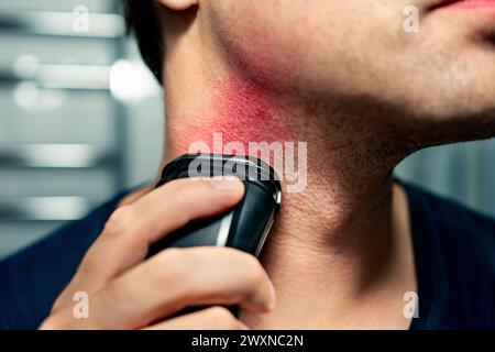 Rasierbrand, Hautausschlag und Hautirritationen. Elektrorasierer. Eingewachsenes Haar im Gesicht. Problem mit der Bartpflegemaschine und dem Trimmer. Mann im Badezimmer. Stockfoto