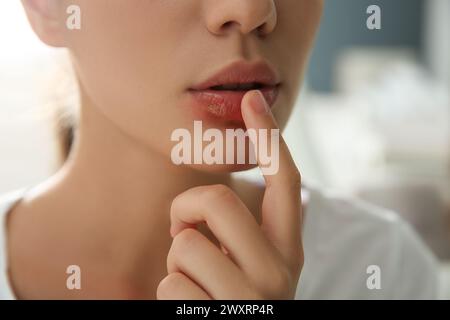 Frau mit Herpes, die Lippen vor verschwommenem Hintergrund berührt, Nahaufnahme Stockfoto