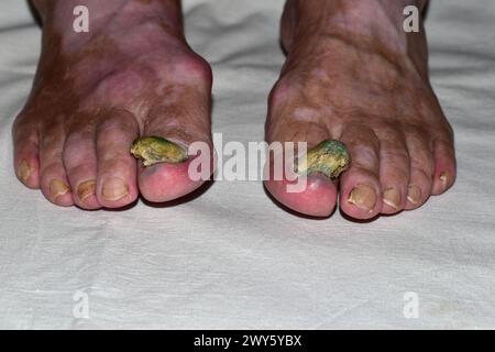 Das Bild zeigt eine Nahaufnahme der Füße an den großen Zehen, die durch Nagelschäden durch den Pilz gewachsen sind. Stockfoto