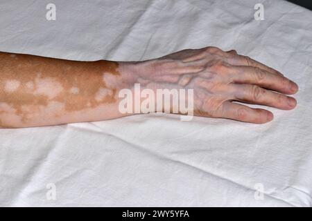 Das Bild zeigt eine Nahaufnahme der rechten Hand einer älteren Frau, die durch die Krankheit Vitiligo geschädigt wurde und auf weiß liegt. Stockfoto