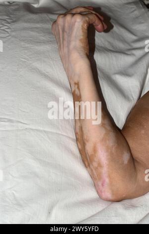 Das Bild zeigt eine Nahaufnahme des rechten Arms, der am Ellenbogen gebogen ist, eine ältere Frau, die durch Vitiligo-Krankheit geschädigt wurde, auf weiß liegend. Stockfoto