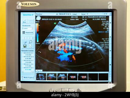 3D-geburtshilflicher Ultraschall, Gynäkologie, Krankenhaus Policlinica Gipuzkoa, San Sebastian, Donostia, Euskadi, Spanien. Stockfoto