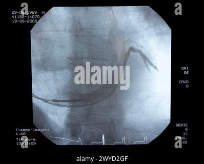 Angiographie, Implantation von ICD (Automatic Implantierbare Cardioverter Defibrillator), interventionelle und vaskuläre Radiologie, Hämodynamik. Krankenhaus Universitario Gran Canaria Arzt Negrin, Las Palmas de Gran Canaria. Kanarische Inseln, Spanien. Stockfoto