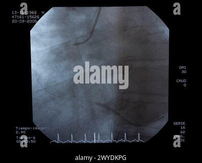 Angiographie, Implantation von ICD (Automatic Implantierbare Cardioverter Defibrillator), interventionelle und vaskuläre Radiologie, Hämodynamik. Krankenhaus Universitario Gran Canaria Arzt Negrin, Las Palmas de Gran Canaria. Kanarische Inseln, Spanien. Stockfoto