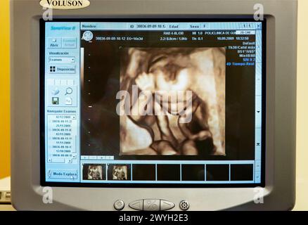 3D geburtshilflicher Ultraschall eines Fetus, 4D Baby Scan zeigt Bewegung, Gynäkologie, Krankenhaus Policlinica Gipuzkoa, San Sebastian, Donostia, Euskadi, Spanien. Stockfoto