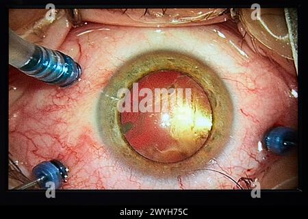 Chirurgische Intervention der Augen, Katarakt, Operationssaal der Augenheilkunde, Krankenhaus Donostia, San Sebastian, Gipuzkoa, Baskenland, Spanien. Stockfoto