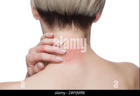 Mädchen mit blonden Haaren, sitzt mit gedrehtem Rücken und kratzt gebissen, rote, geschwollene Nackenhaut von Mückenstichen im Sommer im Wald. Clo Stockfoto