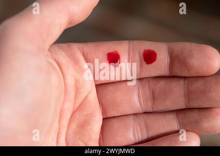 Bluttropfen auf den verwundeten Finger, offene Hand, Hand. Fingerschnitt, Blutung verletzt mit dem Messer, Fleischblutwunde in der Hand. Stockfoto