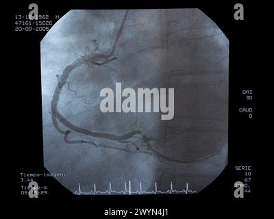 Angiographie, Implantation von ICD (Automatic Implantierbare Cardioverter Defibrillator), interventionelle und vaskuläre Radiologie, Hämodynamik. Krankenhaus Universitario Gran Canaria Arzt Negrin, Las Palmas de Gran Canaria. Kanarische Inseln, Spanien. Stockfoto