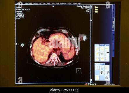 PET-CT Siemens Biograph Bild, kombinierte Apparatur für Positronen-Emissions-Tomographie PET und Röntgen-Computertomographie CT, Nuklearmedizin, Onkologikoa Hospital, Oncology Institute, Case Center for Prevention, Diagnosis and treatment of Cancer, Donostia, San Sebastian, Gipuzkoa, Baskenland, Spanien. Stockfoto