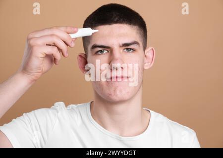 Junger Mann mit Akneproblem, der kosmetisches Produkt auf seiner Haut auf beigem Hintergrund aufträgt Stockfoto