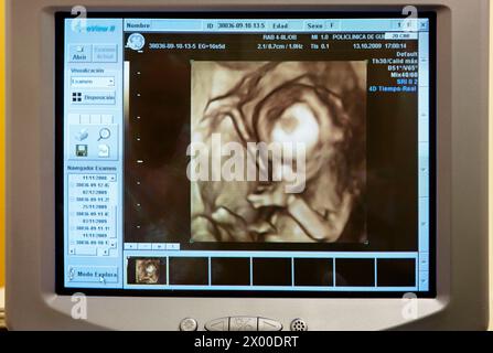 3D geburtshilflicher Ultraschall eines Fetus, 4D Baby Scan zeigt Bewegung, Gynäkologie, Krankenhaus Policlinica Gipuzkoa, San Sebastian, Donostia, Euskadi, Spanien. Stockfoto