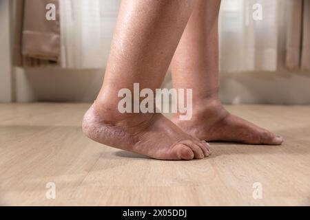 Das Bein der Frau ist ein Ödem (Schwellung) nach Krebsbehandlung. Stockfoto