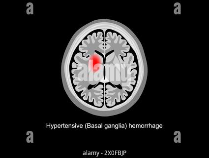 Illustratives Bild einer hypertensiven Blutung im Basalganglienbereich des Gehirns. Stock Vektor