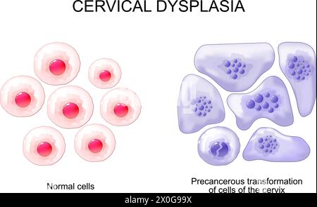 Zervikale Dysplasie. Nahaufnahme normaler Plattenepithelzellen und atypische präkanzeröse Transformation der Zervixzellen. Das Zervixkarzinom. Cer Stock Vektor