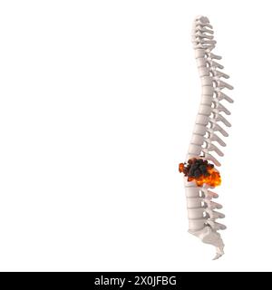 3D-Rendering einer menschlichen Wirbelsäule mit dem Konzept eines Bandscheibenvorfalls an Lendenwirbeln Stockfoto