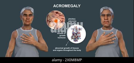 3D-Illustration, die einen gesunden Mann (links) und denselben Mann mit Akromegalie (rechts) vergleicht. Akromegalie ist eine Erkrankung, die aufgrund der Überproduktion von Somatotropin (menschliches Wachstumshormon) eine Zunahme der Hände und des Gesichts verursacht. Sie ist typischerweise das Ergebnis eines gutartigen Tumors (Adenoms), der sich auf der Hypophyse bildet. Stockfoto