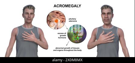 3D-Illustration, die einen gesunden Mann (links) und denselben Mann mit Akromegalie (rechts) vergleicht. Akromegalie ist eine Erkrankung, die aufgrund der Überproduktion von Somatotropin (menschliches Wachstumshormon) eine Zunahme der Hände und des Gesichts verursacht. Sie ist typischerweise das Ergebnis eines gutartigen Tumors (Adenoms), der sich auf der Hypophyse bildet. Stockfoto