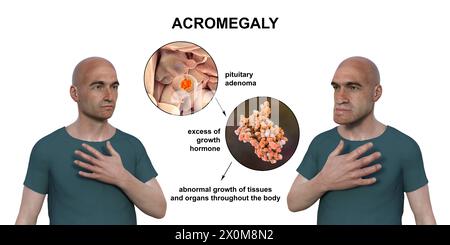 3D-Illustration, die einen gesunden Mann (links) und denselben Mann mit Akromegalie (rechts) vergleicht. Akromegalie ist eine Erkrankung, die aufgrund der Überproduktion von Somatotropin (menschliches Wachstumshormon) eine Zunahme der Hände und des Gesichts verursacht. Sie ist typischerweise das Ergebnis eines gutartigen Tumors (Adenoms), der sich auf der Hypophyse bildet. Stockfoto