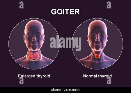 3D-Illustration einer Person mit einer vergrößerten Schilddrüse (Halsbasis), bekannt als Struma, und derselben Person mit einer gesunden Schilddrüse (rechts) zum Vergleich. Stockfoto