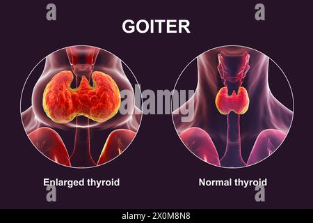 3D-Illustration einer Person mit einer vergrößerten Schilddrüse (Halsbasis), bekannt als Struma, und derselben Person mit einer gesunden Schilddrüse (rechts) zum Vergleich. Stockfoto