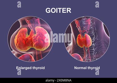 3D-Illustration einer Person mit einer vergrößerten Schilddrüse (Halsbasis), bekannt als Struma, und derselben Person mit einer gesunden Schilddrüse (rechts) zum Vergleich. Stockfoto