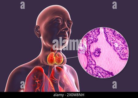 3D-Illustration einer Person mit einer toxischen Struma (vergrößerte Schilddrüse, Nackenbasis) und einer Nahaufnahme des betroffenen Schilddrüsengewebes. Eine Struma gilt als toxisch, wenn die vergrößerte Schilddrüse ebenfalls übermäßiges Schilddrüsenhormon produziert. Stockfoto