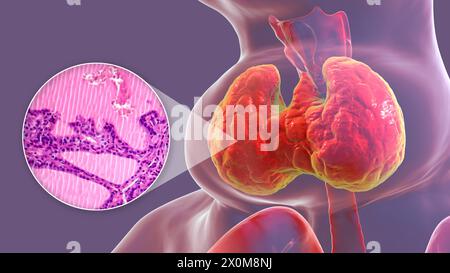 3D-Illustration einer Person mit einer toxischen Struma (vergrößerte Schilddrüse, Nackenbasis) und einer Nahaufnahme des betroffenen Schilddrüsengewebes. Eine Struma gilt als toxisch, wenn die vergrößerte Schilddrüse ebenfalls übermäßiges Schilddrüsenhormon produziert. Stockfoto