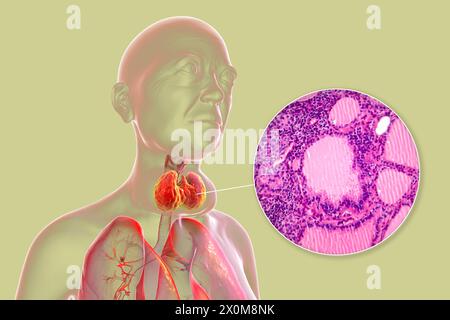 3D-Illustration einer Person mit einer toxischen Struma (vergrößerte Schilddrüse, Nackenbasis) und einer Nahaufnahme des betroffenen Schilddrüsengewebes. Eine Struma gilt als toxisch, wenn die vergrößerte Schilddrüse ebenfalls übermäßiges Schilddrüsenhormon produziert. Stockfoto