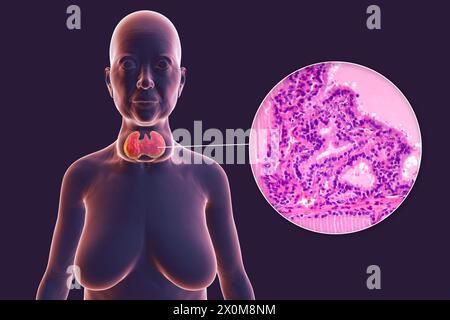 3D-Illustration einer Person mit einer toxischen Struma (vergrößerte Schilddrüse, Nackenbasis) und einer Nahaufnahme des betroffenen Schilddrüsengewebes. Eine Struma gilt als toxisch, wenn die vergrößerte Schilddrüse ebenfalls übermäßiges Schilddrüsenhormon produziert. Stockfoto