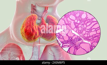 3D-Illustration einer Person mit einer toxischen Struma (vergrößerte Schilddrüse, Nackenbasis) und einer Nahaufnahme des betroffenen Schilddrüsengewebes. Eine Struma gilt als toxisch, wenn die vergrößerte Schilddrüse ebenfalls übermäßiges Schilddrüsenhormon produziert. Stockfoto