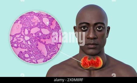 3D-Illustration eines Mannes mit einer vergrößerten Schilddrüse (Struma, Halsbasis) und einer Nahaufnahme des betroffenen Thymusgewebes. Stockfoto