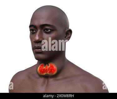 3D-Illustration eines Mannes mit einer vergrößerten Schilddrüse (Halsbasis), bekannt als Struma. Stockfoto