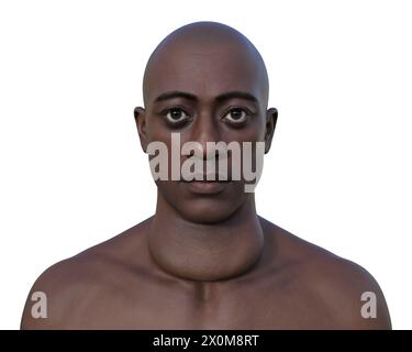 3D-Darstellung eines Mannes mit einer vergrößerten Schilddrüse (Struma, Halsbasis) und abnormer Augenvorwölbung (Exophthalmus). Dies sind zwei Symptome einer überaktiven Schilddrüse, bekannt als Hyperthyreose. Stockfoto