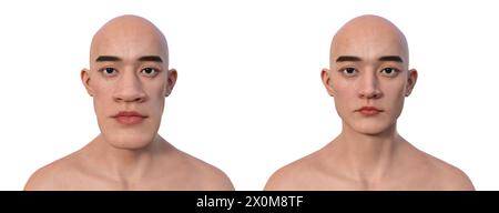 3D-Illustration, die einen Mann mit Akromegalie (links) und denselben gesunden Mann (rechts) vergleicht. Akromegalie ist eine Erkrankung, die eine Vergrößerung der Körperteile einschließlich der Gesichtszüge verursacht. Sie wird durch eine Überproduktion von Somatotropin (menschliches Wachstumshormon) verursacht, die typischerweise durch einen gutartigen Tumor (Adenom) verursacht wird, der sich auf der Hypophyse bildet. Stockfoto