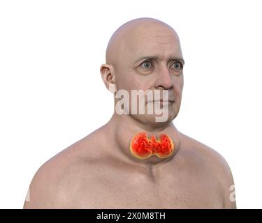 3D-Darstellung eines Mannes mit einer vergrößerten Schilddrüse (Struma, Halsbasis) und abnormer Augenvorwölbung (Exophthalmus). Dies sind zwei Symptome einer überaktiven Schilddrüse, bekannt als Hyperthyreose. Stockfoto