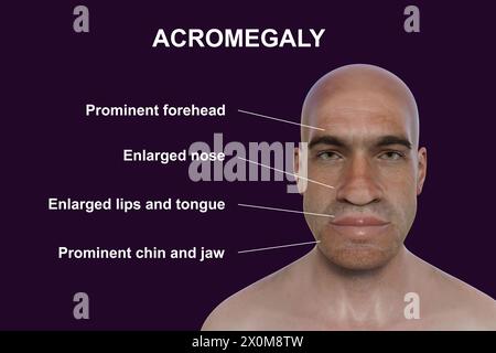 3D-Illustration eines Mannes mit Akromegalie. Dies ist eine Erkrankung, die aufgrund der Überproduktion von Somatotropin (menschliches Wachstumshormon) zu einer Vergrößerung der Hände und des Gesichts führt. Sie ist typischerweise das Ergebnis eines gutartigen Tumors (Adenoms), der sich auf der Hypophyse bildet. Stockfoto