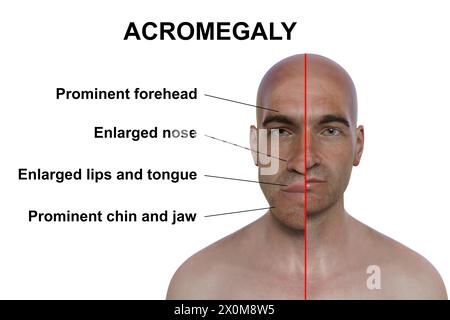 3D-Illustration, die einen Mann mit Akromegalie (links) und denselben gesunden Mann (rechts) vergleicht. Akromegalie ist eine Erkrankung, die eine Vergrößerung der Körperteile einschließlich der Gesichtszüge verursacht. Sie wird durch eine Überproduktion von Somatotropin (menschliches Wachstumshormon) verursacht, die typischerweise durch einen gutartigen Tumor (Adenom) verursacht wird, der sich auf der Hypophyse bildet. Stockfoto