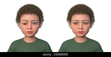 Illustration eines Kindes mit Hypotropie, das nach unten gerichtete Augenfehlstellungen zeigt, und des gleichen gesunden Kindes. Stockfoto