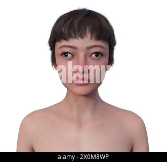 Illustration einer Exotropie-Frau mit Augenfehlstellung nach außen. Stockfoto